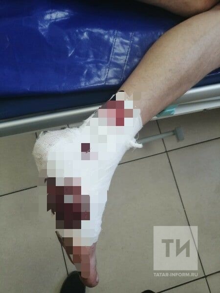 В Челнах собака разодрала ногу мужчине